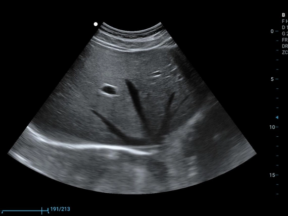 Mobilny aparat USG Zoncare M70 z głowicą liniową i convex
