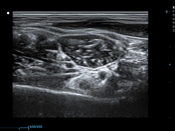 Mobilny aparat USG Zoncare M70 z głowicą liniową, convex i transwaginalną
