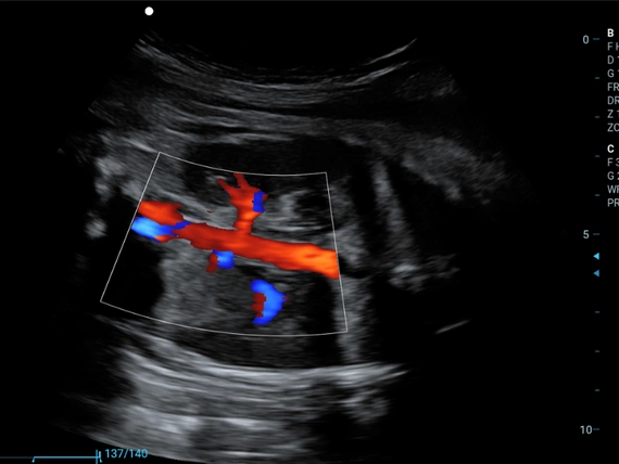 Mobilny aparat USG Zoncare M70 z głowicą liniową, convex i transwaginalną