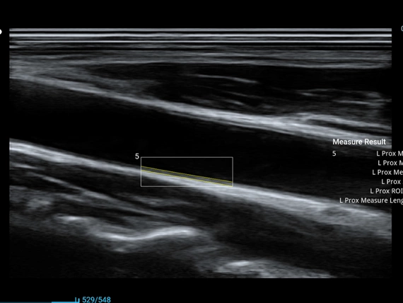 Mobilny aparat USG Zoncare M70 z głowicą liniową, convex i transwaginalną