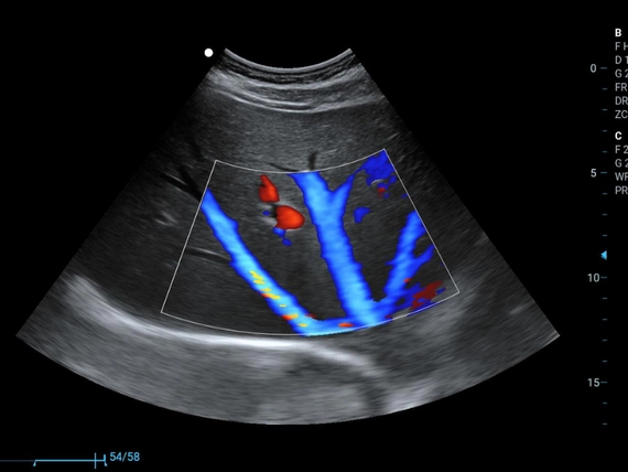 Mobilny aparat USG Zoncare M70 z głowicą convex