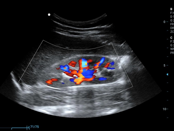 Mobilny aparat USG Zoncare M70 z głowicą liniową