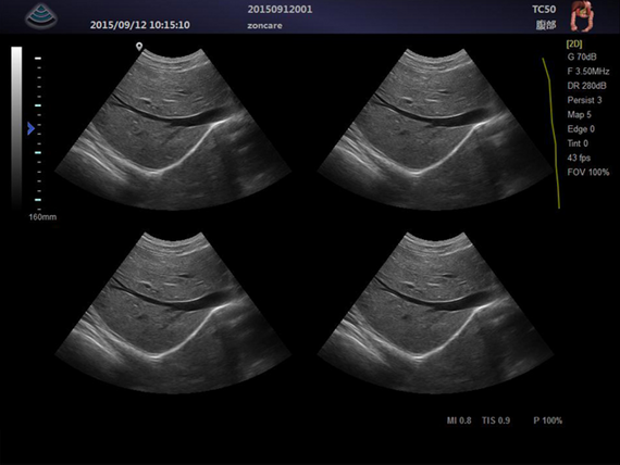 Aparat ultrasonograficzny Zoncare M5 z głowicą kardiologiczną